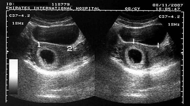 Early Pregnancy Ultrasound